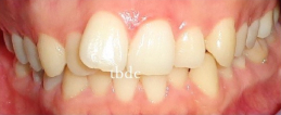裏側ワイヤー部分矯正の治療前（症例写真）