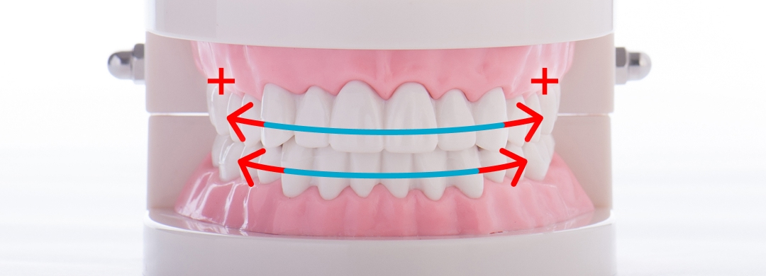 部分矯正プラス＋
