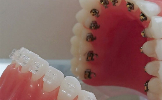 ハーフリンガル部分矯正