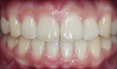 歯科矯正-ビフォーアフター症例写真-矯正後-マウスピース矯正（インビザライン）-上下の前歯の前後関係が逆になっていた歯並び