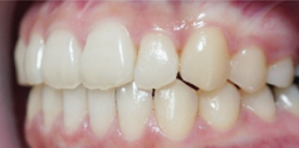 歯科矯正-ビフォーアフター症例写真-矯正後-マウスピース矯正（インビザライン）-上下の前歯の前後関係が逆になっていた歯並び