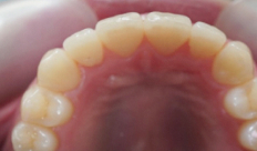 歯科矯正-ビフォーアフター症例写真-矯正後-マウスピース矯正（インビザライン）-上下の前歯の前後関係が逆になっていた歯並び