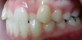 歯科矯正-ビフォーアフター症例写真-矯正前-マウスピース矯正（インビザライン）-上下の前歯の前後関係が逆になっていた歯並び