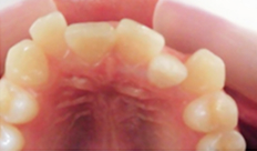 歯科矯正-ビフォーアフター症例写真-矯正前-マウスピース矯正（インビザライン）-上下の前歯の前後関係が逆になっていた歯並び