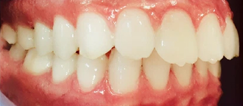 歯科矯正-ビフォーアフター症例写真（マウスピース矯正-出っ歯）