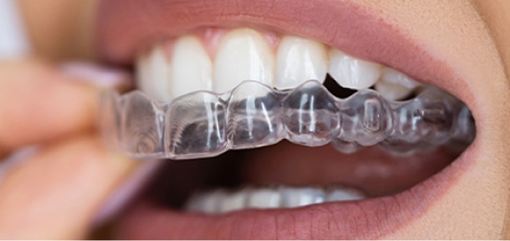 インビザライン 透明なマウスピース矯正の装着イメージ