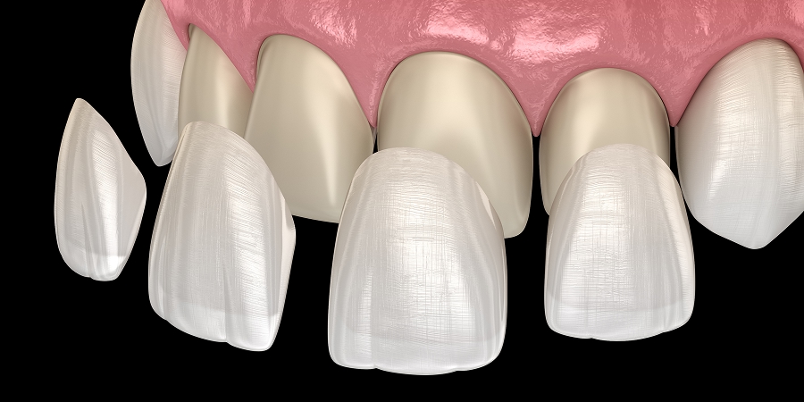 ラミネートベニアのイメージ画像