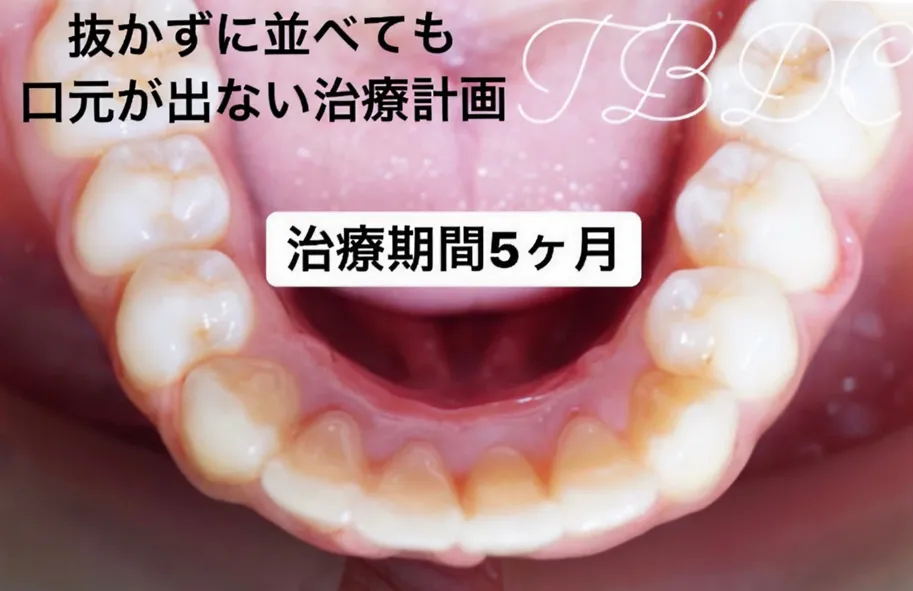 歯科矯正-ビフォーアフター症例写真-矯正後-マウスピース矯正（インビザライン）-歯のガタつき