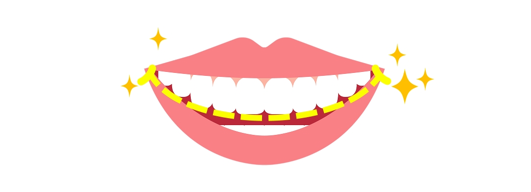 前歯を削る審美治療（歯の形態修正）