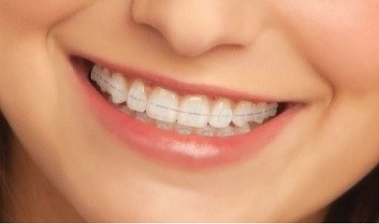 表側ワイヤー部分矯正