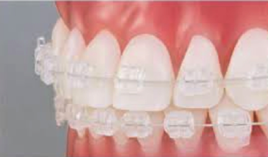 目立たない透明な表側ワイヤー矯正の写真