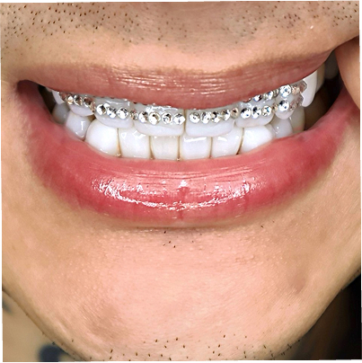 ティースジュエリー（トゥースジェム）のデザイン-写真