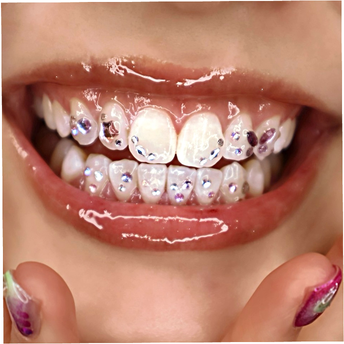 ティースジュエリー（トゥースジェム）のデザイン-写真