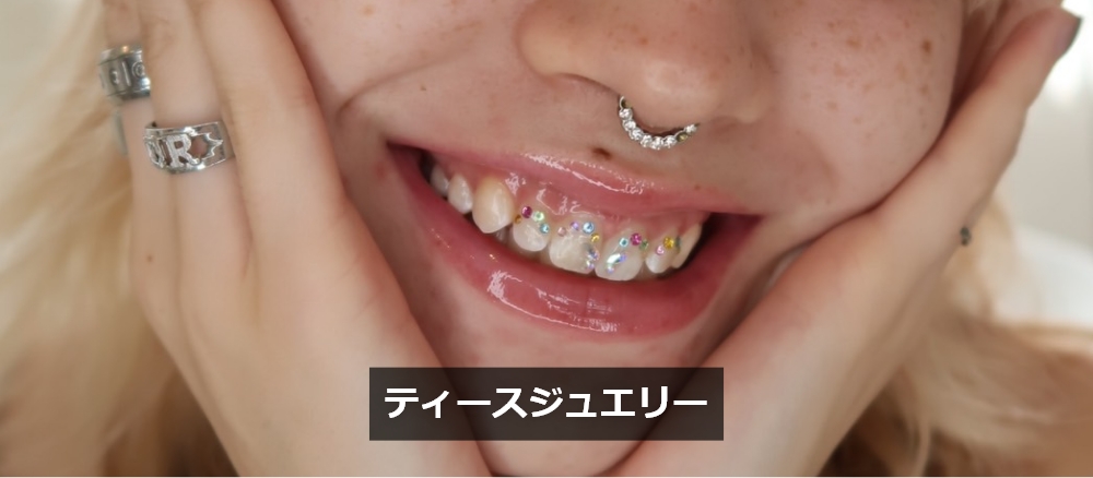 ジュエリーマウスピース矯正