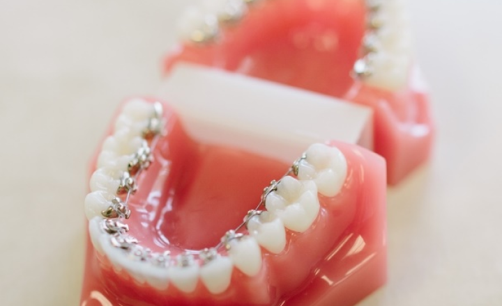 裏側ワイヤー矯正の模型写真