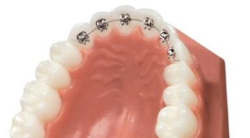 裏側ワイヤー部分矯正