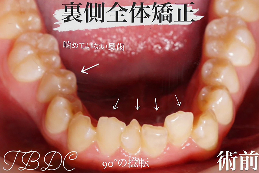 歯科矯正-ビフォーアフター症例写真-矯正前-コラボ矯正（マウスピース矯正×ワイヤー）-歯のガタつき