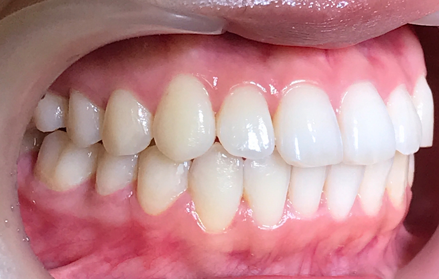 歯科矯正-ビフォーアフター症例写真-矯正後-表側ワイヤー矯正-歯のガタつき