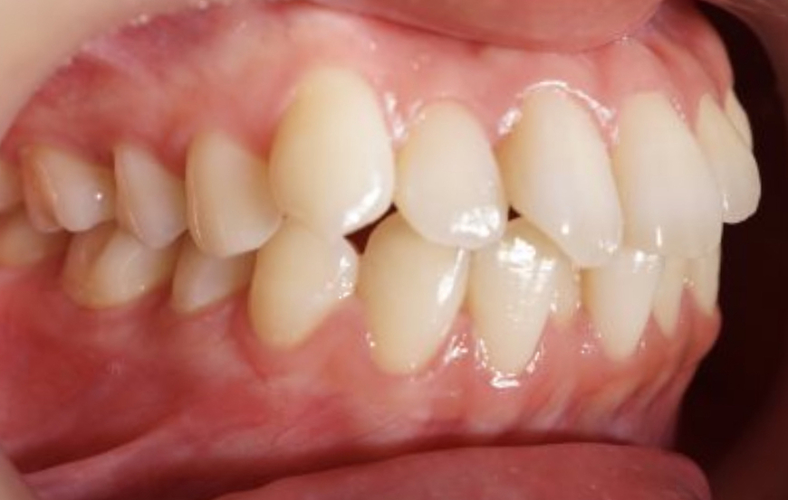 歯科矯正-ビフォーアフター症例写真-矯正前-表側ワイヤー矯正-歯のガタつき